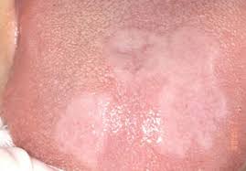 Image result for lichen planus on tongue)