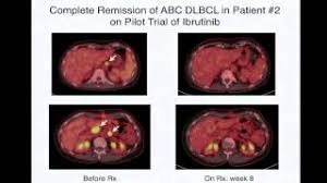 Mediastinum pronunciation simply select a language and press on the speaker button to listen to the pronunciation of the word. Mediastinal 22 Pronunciations Of Mediastinal In English