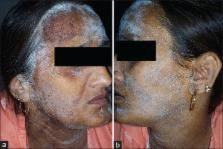 Image result for Anhidrosis