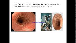Typically there is involvement of the gastric antrum. Esophagitis Usmlestep1 High Yield Cmv Candida Hsv Mallory Weis Borhaave Eosinophilic Esophagitis Youtube