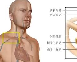 胸郭出口症候群の画像