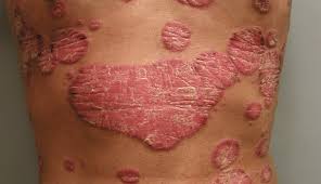 Image result for psoriasis