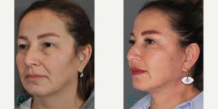 Kerem Sami Kaya, MD, Otolaryngologist