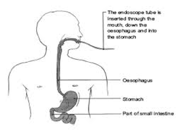 After having so many i know how i react and know. Combined Upper Gi Endoscopy And Colonoscopy Hull University Teaching Hospitals Nhs Trust