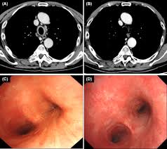 Image result for Relapsing Polychondritis