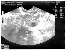 Seperti yang kita ketahui, buah durian sangat dilarang bagi ibuhamil. Pengalaman Keguguran 2019 Kandungan Tidak Menjadi Rezeki Ibu