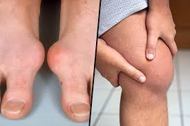 Image result for gout symptoms toe