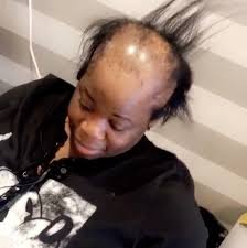 Prepare to discuss different hairstyles for balding men with your barber or hairstylist by looking at photos as inspiration. 610 Alopecia Bald Beauties Ideas In 2021 Balding Bald Women Bald Hair