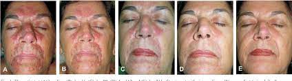 Pimecrolimus Cream 1 Is Effective In A Case Of Granulomatous Rosacea Semantic Scholar