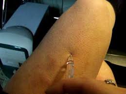 Acetato de glatirâmero mylan, aksoglatiran fs, brabio. Copaxone Injection Youtube
