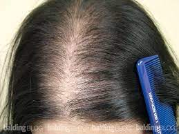 Excess oil is an indicator of dihydroxy testosterone, or dht, one of the main culprits for hair loss, especially in women with hormonal imbalances. How To Treat Female Hair Loss International Shia News Agency