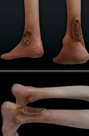 Cher ami (french for dear friend, in the masculine) was a male homing pigeon who had been donated by the pigeon fanciers of britain for use by the u.s. A Intractable Leg Ulcers On The Right Achilles Tendon And Left Lateral Download Scientific Diagram