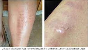 Laser Hair Removal Is It Worth The Risk Beauty Black Book Burns Treatment Laser Hair Removal Treatment