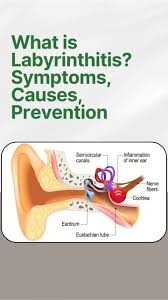 Image result for Bacterial Labyrinthitis