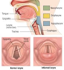 Image result for Acute Laryngitis