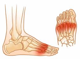 Image result for Metatarsal