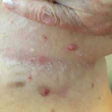 Intertrigo is a common skin disease that primarily affects young children and older adults of all races read on to know what is intertrigo and also learn about its causes, symptoms, diagnosis, remedies. Intertrigo Doccheck Flexikon