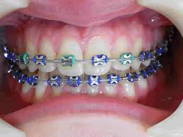 Visit The Best Orthodontist In Nj And Have That Beautiful Smile Contact Http Dryoungortho Com Now Braces Colors Dental Braces Teeth Braces