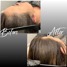 Pin On Scalp Micro Pigmentation