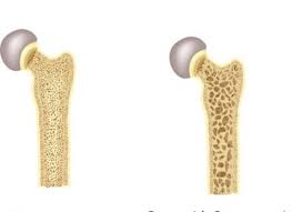 Osteoporosis Icd 10 Cm Coding Aapc Knowledge Center