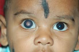 Melanoma of the eye is one of the most common types of eye cancer. Retinoblastoma Aravind Eye Care System