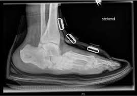 Ackerman s.j., kwatia m.a., savage m.p., leonidas d.d., swaminathan g.s. Versorgungskonzept Beim Diabetischen Charcot Fuss Mit Fokus Auf Typ Sanders 2 4 Orthopadie Technik