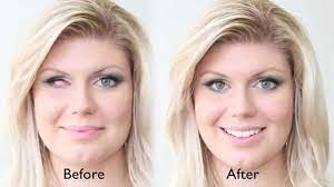 Artificial Eye Prosthetic Eye Patient Of Ocular Prosthetics Inc Youtube