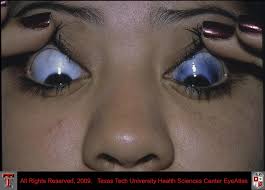 Image result for melanosis sclera