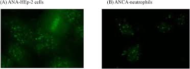 Image result for ANA Staining Pattern