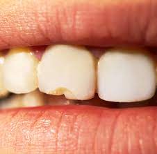 My Child Has A Broken Tooth Now What