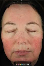 Use of an alternative method to evaluate erythema severity in a clinical  trial: difference in vehicle response with evaluation o