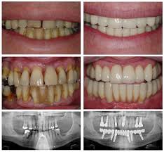 When you do this without fail, you will start to notice the gap close after several nights. How To Close A Gap In Teeth Without Braces Windsor Dental