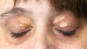 Image result for xanthelasma of eyelid
