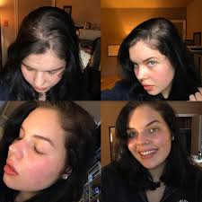Advice Wanted Growing Out Black Dye Makes Roots Looks Gray Nonexistent How To Grow Out Dye Gracefully Is Bleach An Grow Black Hair Black Hair Dye Roots Hair
