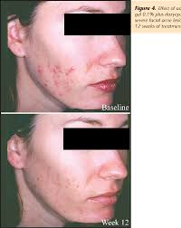 Figure 4 from Combination therapy with adapalene gel 0.1% and doxycycline  for severe acne vulgaris: a multicenter, investigator-blind, randomized,  controlled study.