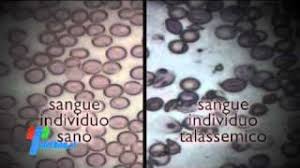Talassemia minor, talassemia major e talassemia intermédia. Talassemia