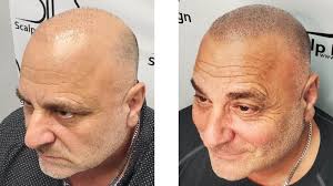 Before and After Photos of Scalp Micropigmentation (SMP)