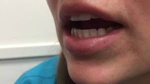 Image result for Trismus