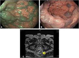 Image result for Colonoscopy in GI Bleeding