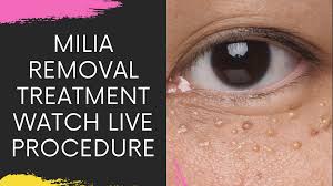 Image result for milium cyst on eyelid