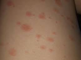 A severe case of chilblains can cause sores or blisters. Rashes Can Occur After Covid Vaccine But Dermatologists Say Don T Worry Health News Us News