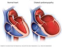 Image result for icd 10 cm code for dilated cardiomyopathy