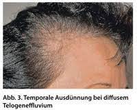 Haarausfall Bei Frauen Ursachen Und Behandlung Doctors Today