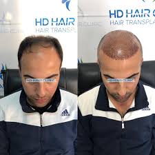 6500 Greft Ekimi Ile Max Sayi Natural On Cizgi Ve Profesyonel Ekibin Ellerinde Bizimle Guvendesiniz الان في مركز اسطنبول لزراعة الشع Hair Clinic Hair Clinic