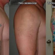 See results after 3 treatments. Fade Fast Laser Tattoo Removal Ferme 11 Photos Detatouage 2875 E Joyce Blvd Fayetteville Ar Etats Unis