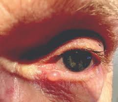 Image result for milium cyst on eyelid