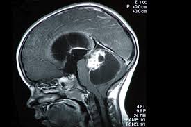 The symptoms you are experiencing are linked to the location of the tumor in your brain. New Hope For Children With Brain Tumors Harvard Gazette