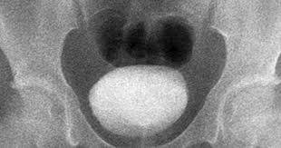 Image result for Voiding Cystourethrogram