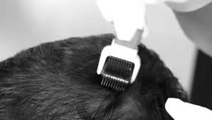 Treatment for hair loss in delhi, find doctors near you. Best Hair Fall Treatment Doctor In Delhi Hair Loss Clinic In South Delhi Greater Kailash