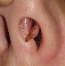 Image result for cornu cutaneum)